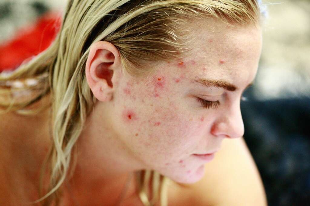 Adult Female Acne