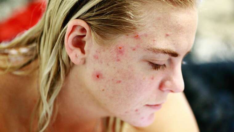 Acne