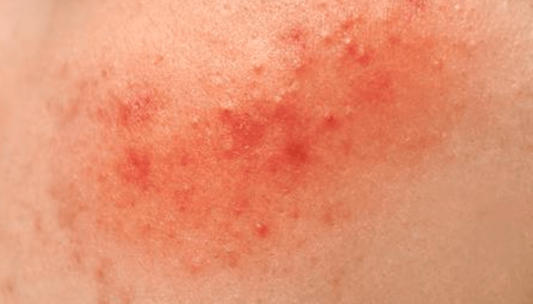 Skin Rashes