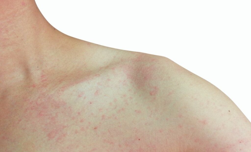 Skin Rashes: When To See A Dermatologist - Goodless Dermatology